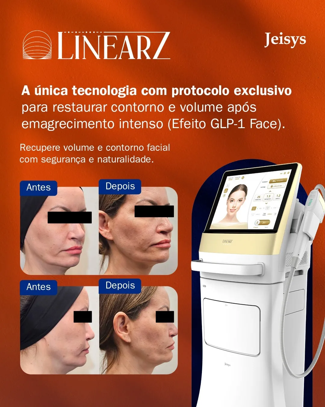 LinearZ Jeisys, protocolo para restauração de contorno e volume após emagrecimento intenso (GLP-1 Face)