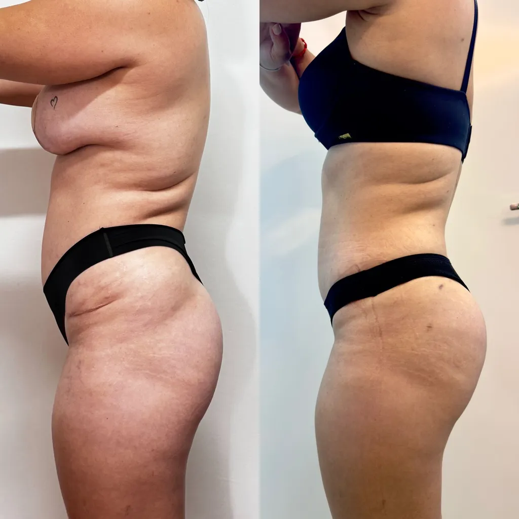 Antes e depois de tratamento de flanco e abdômen, vista lateral